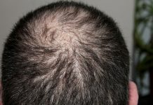 Alopezie kann viele Gründe haben.