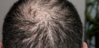 Alopezie kann viele Gründe haben.